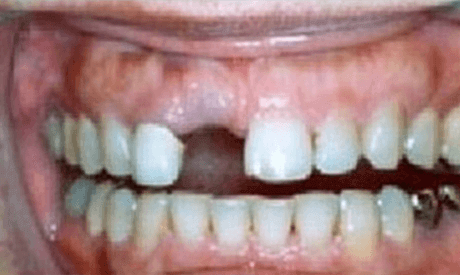 before dental implants/></span>
                        <span><img src=