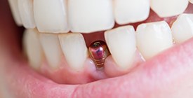 a person with a dental implant that hasn’t been restored yet in their mouth