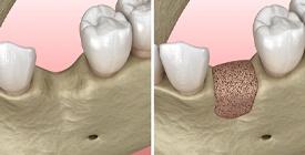 Diagram of how bone grafting in Roselle Park works for dental implants