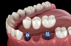 Diagram of how bone grafting in Roselle Park works for dental implants