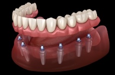 Diagram of a sinus lift in Roselle Park for dental implants