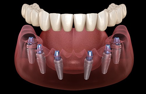 Implant dentures illustration
