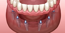 a 3 D illustration of an implant denture