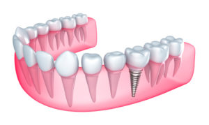 With dental implants from your cosmetic dentist in Roselle Park, you can enjoy a full smile. 