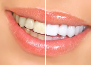 Before and after teeth whitening in Roselle Park.