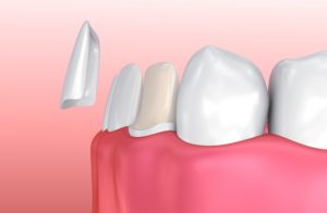 Computer model of veneer and prepped tooth