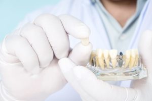 Dentist blurry in the background holding parts of a model dental implant to the foreground